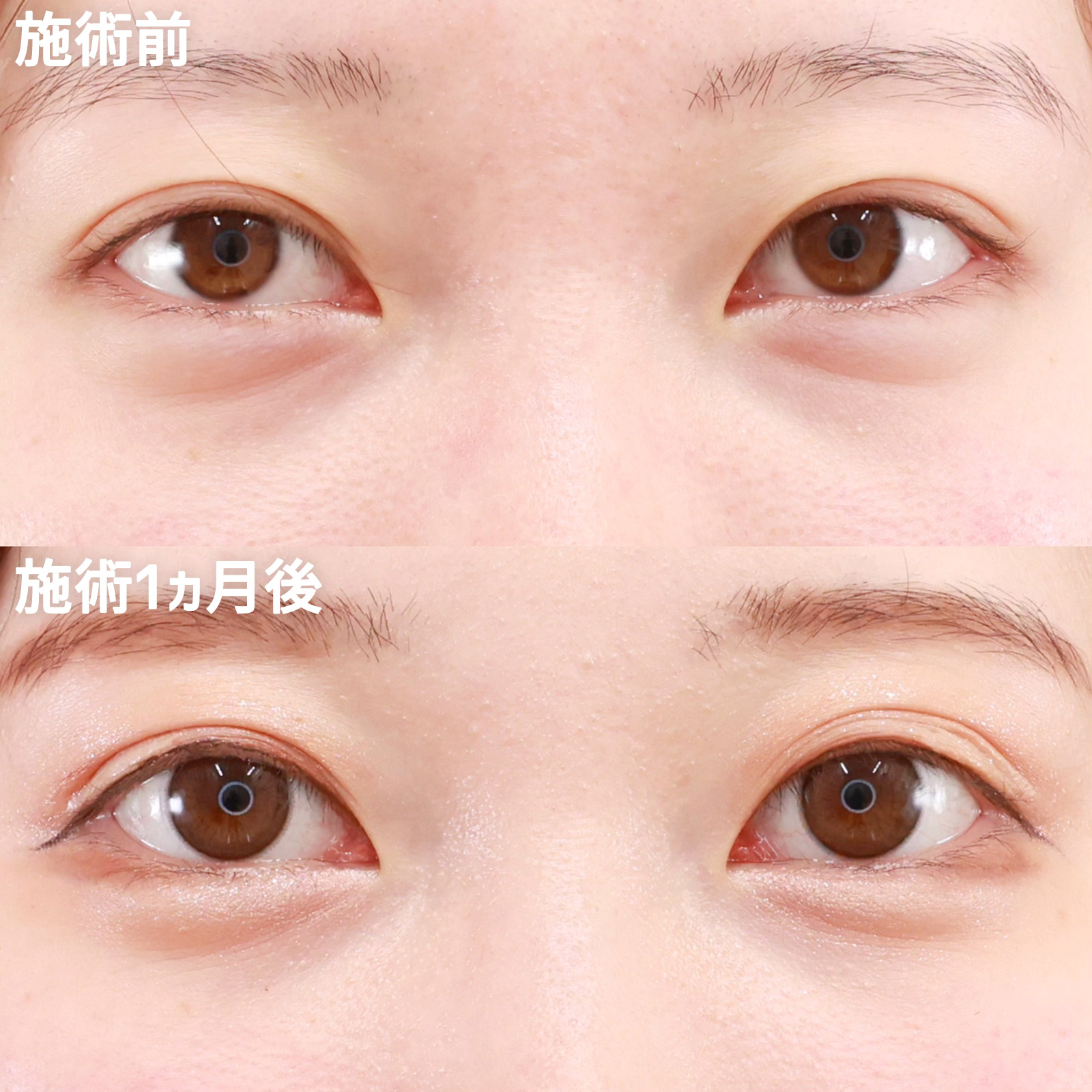 グラマラスライン（タレ目形成）の症例写真 施術前後 