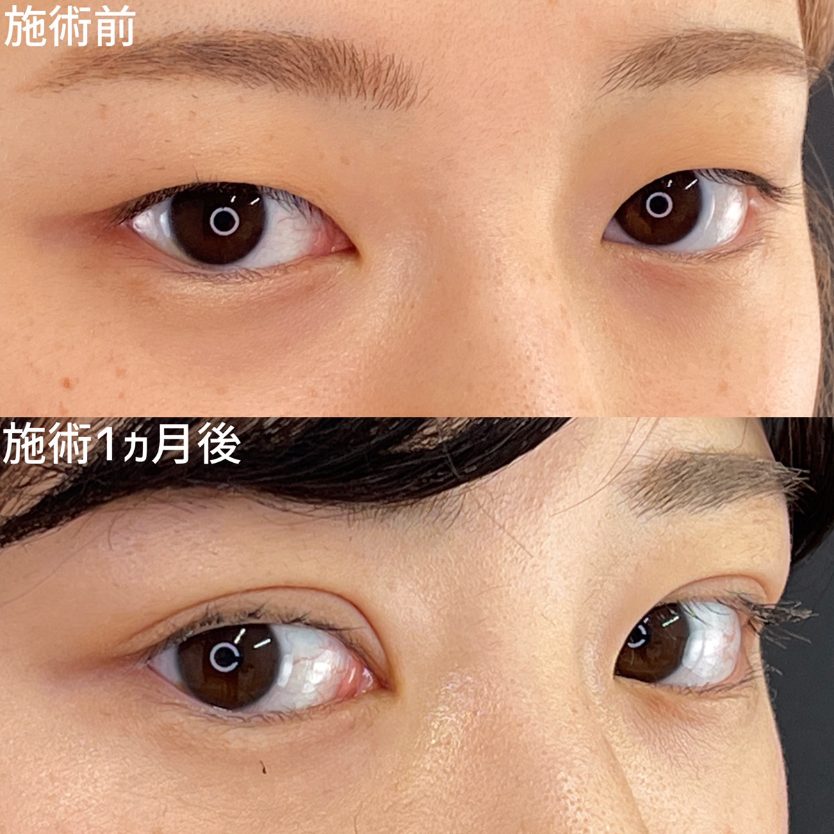二重埋没法/目元：その他の症例写真 施術前後 