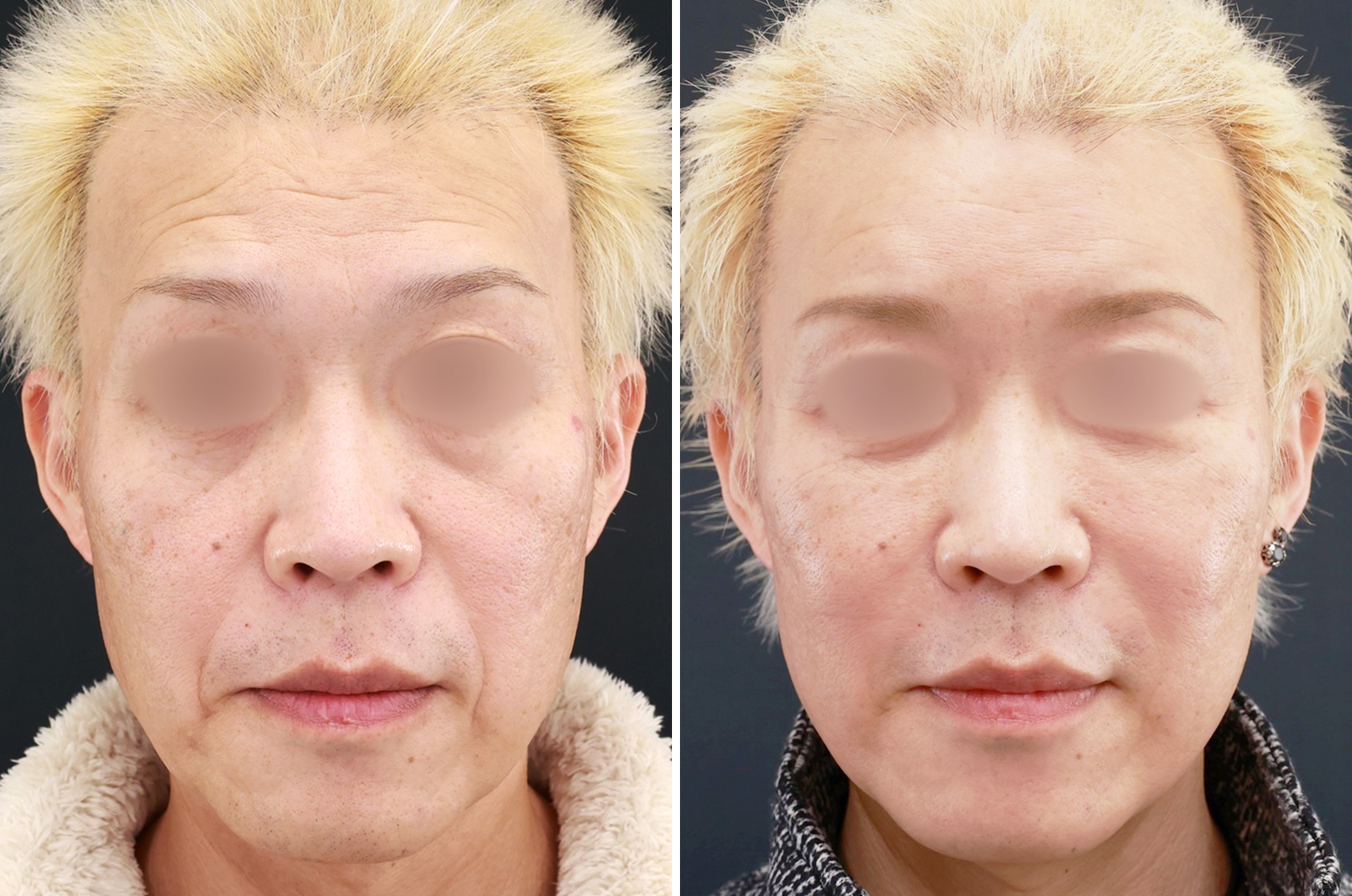 エイジングケアにはこれ！お顔の脂肪注入とクマ取りで見違えるほど若々しく