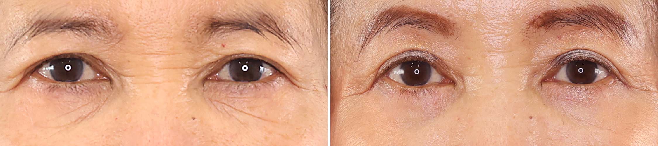 【下眼瞼切開術】で目の下のお悩みをスッキリ改善！