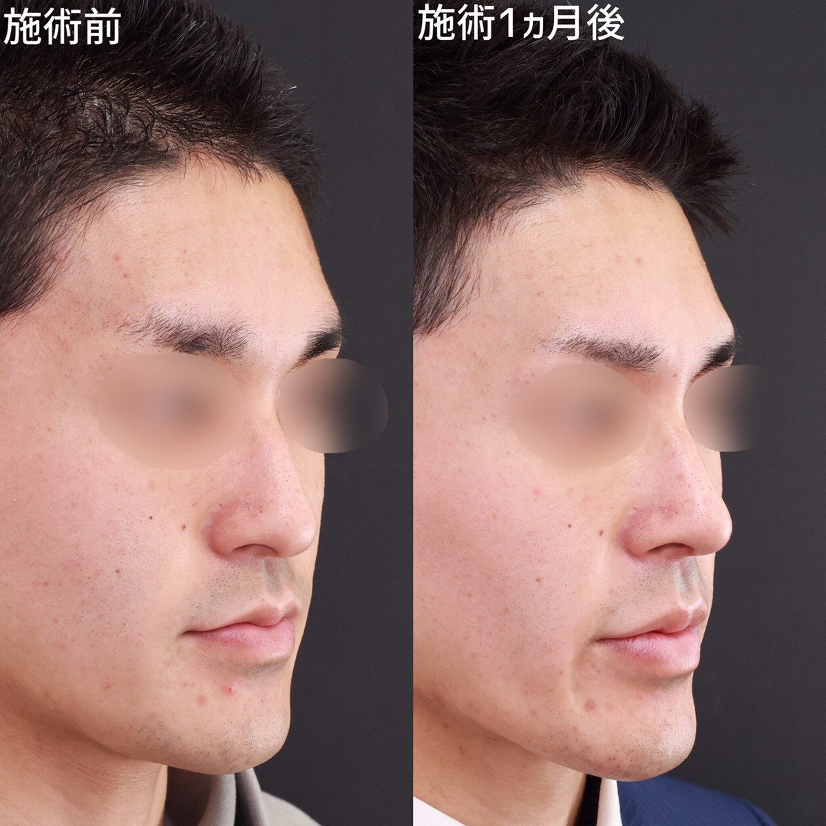 鼻尖形成・鼻尖縮小/鼻先軟骨移植/鼻のヒアルロン酸注射の症例写真 施術前後 