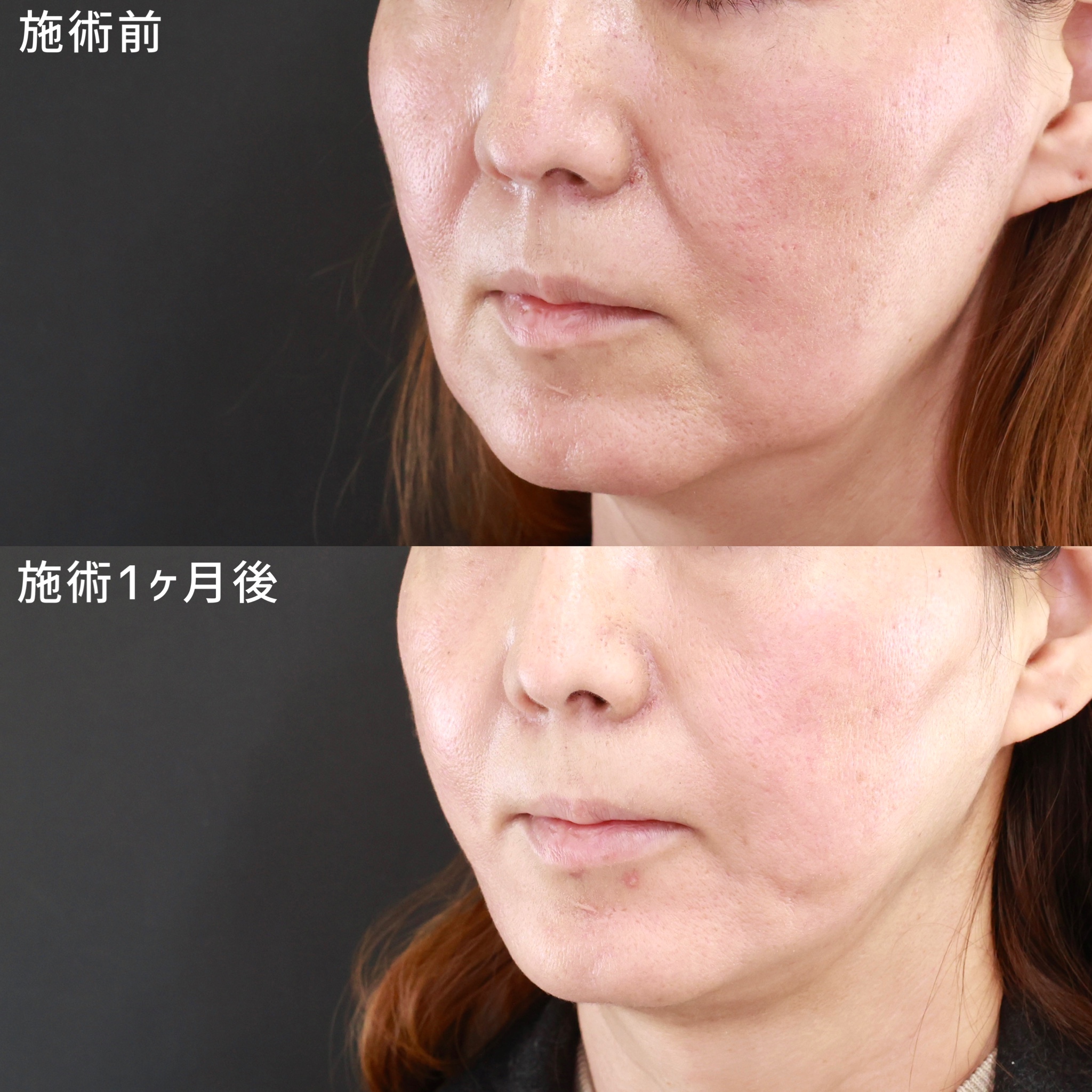 TAC式 ツヤ肌コラーゲンリフト®/ジョールファット除去の症例写真 施術前後  施術前・施術１ヵ月後
