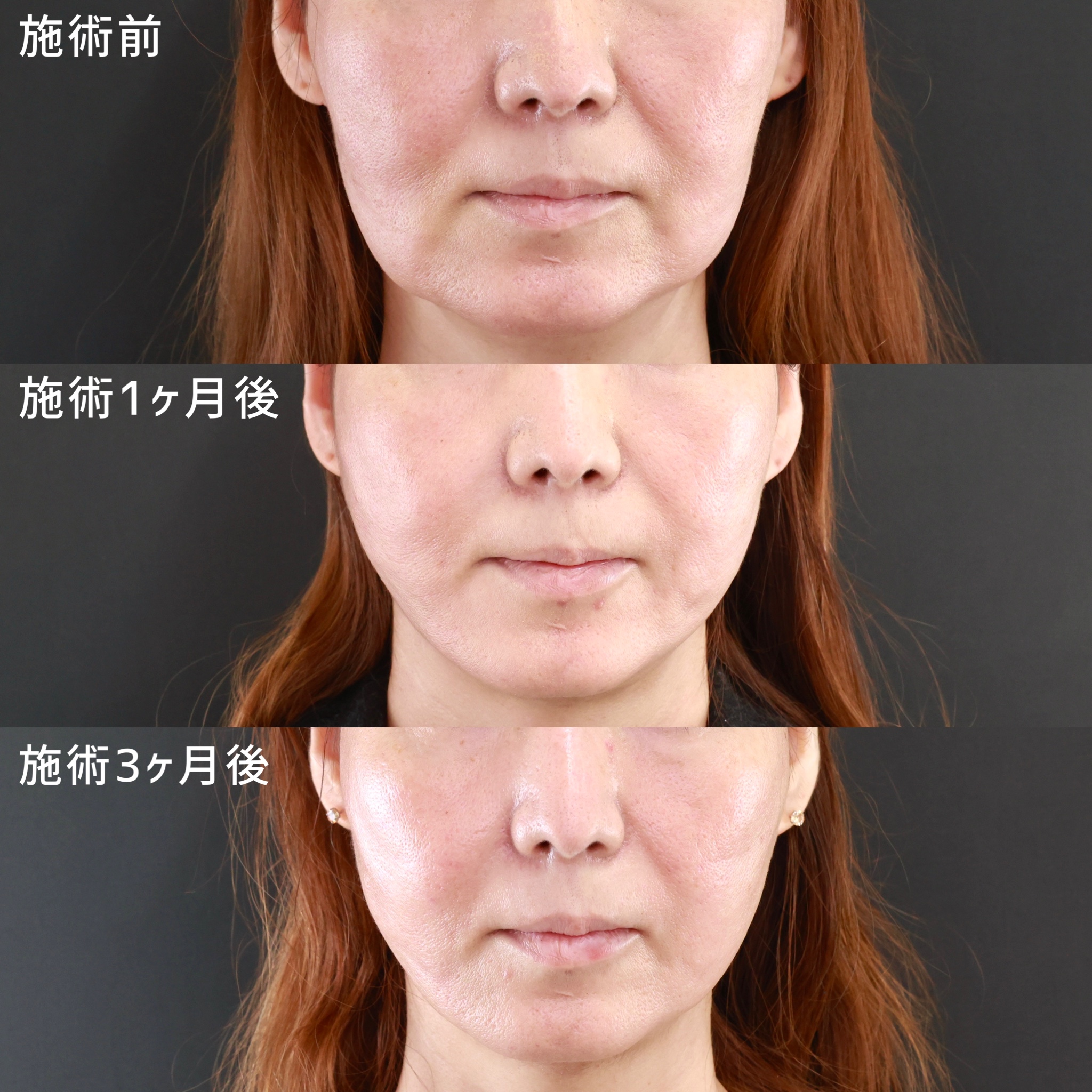 TAC式 ツヤ肌コラーゲンリフト®/ジョールファット除去の症例写真 施術前後  施術前～施術3ヵ月後