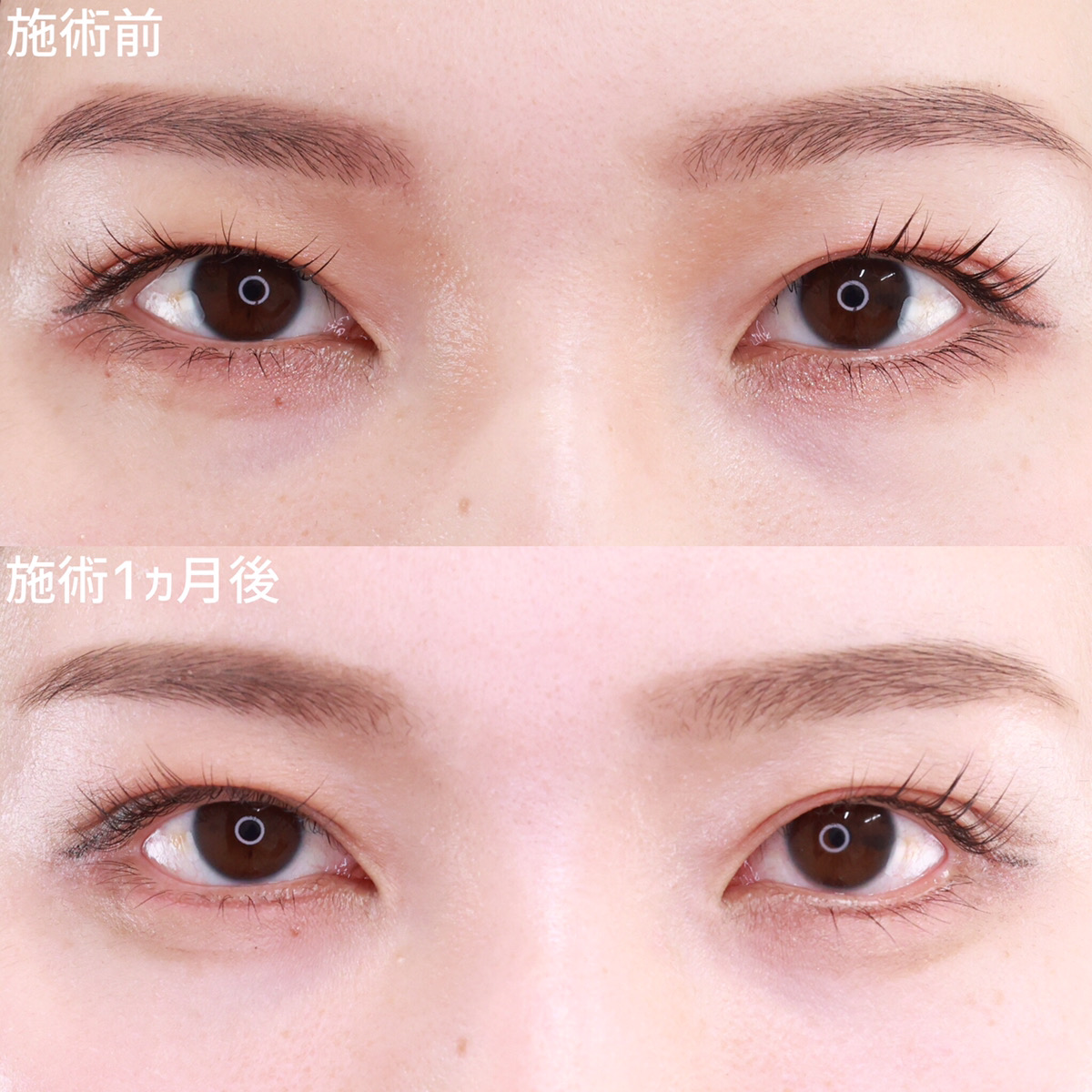 グラマラスライン（タレ目形成）の症例写真 施術前後 