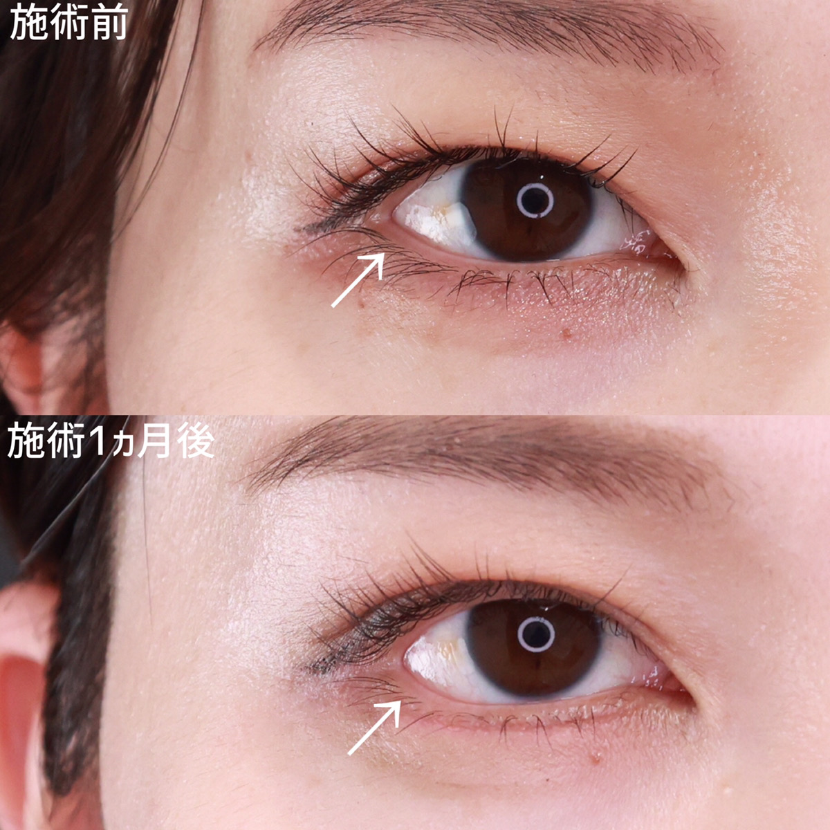 グラマラスライン（タレ目形成）の症例写真 施術前後 