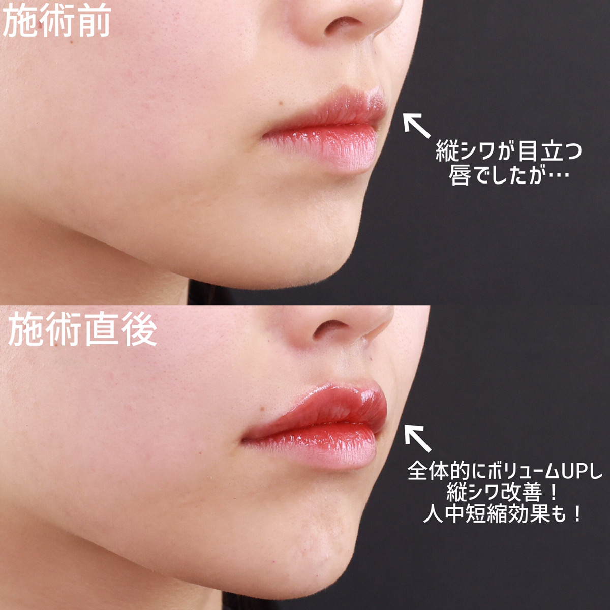 ヒアルロン酸注射：その他の症例写真 施術前後 