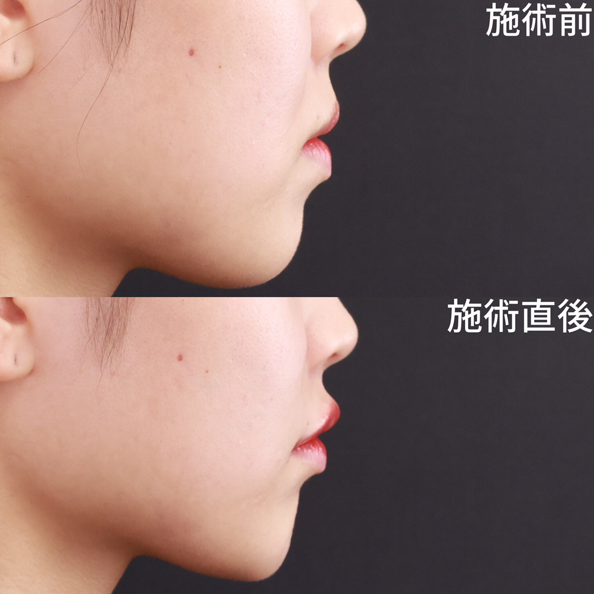 ヒアルロン酸注射：その他の症例写真 施術前後 