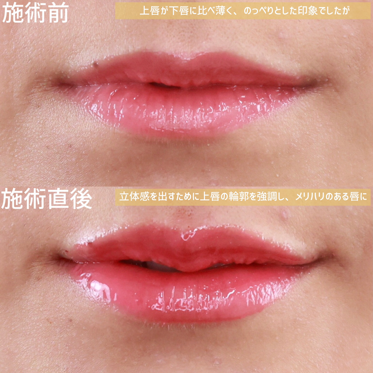 ヒアルロン酸注射：その他/M字リップ形成術の症例写真 施術前後 