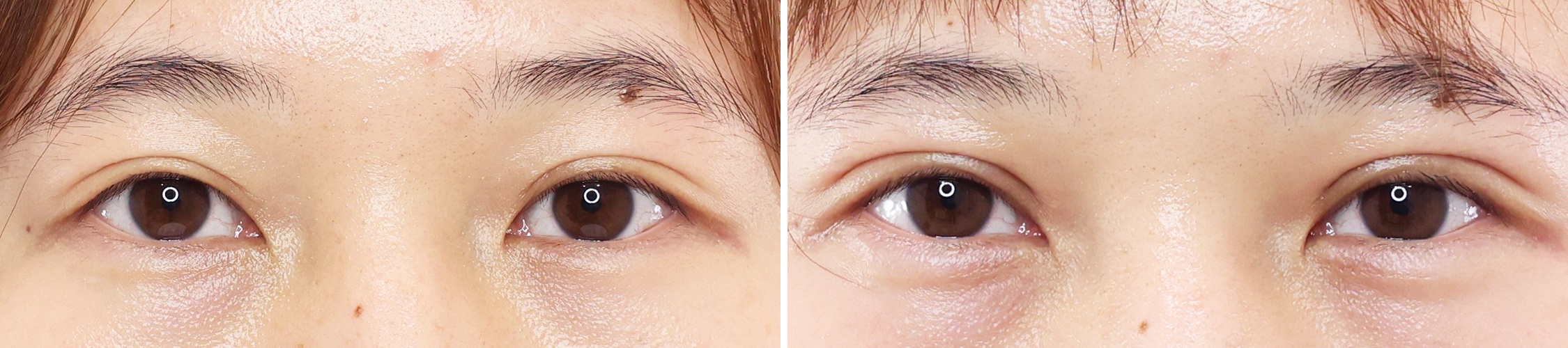 上眼瞼切開術の症例写真 施術前後 １ヵ月