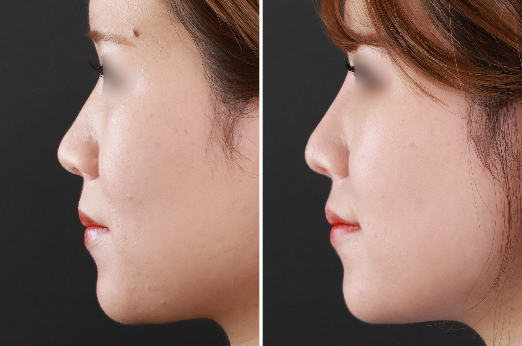 お悩みをピンポイントで解決！オーダーメイドの鼻整形