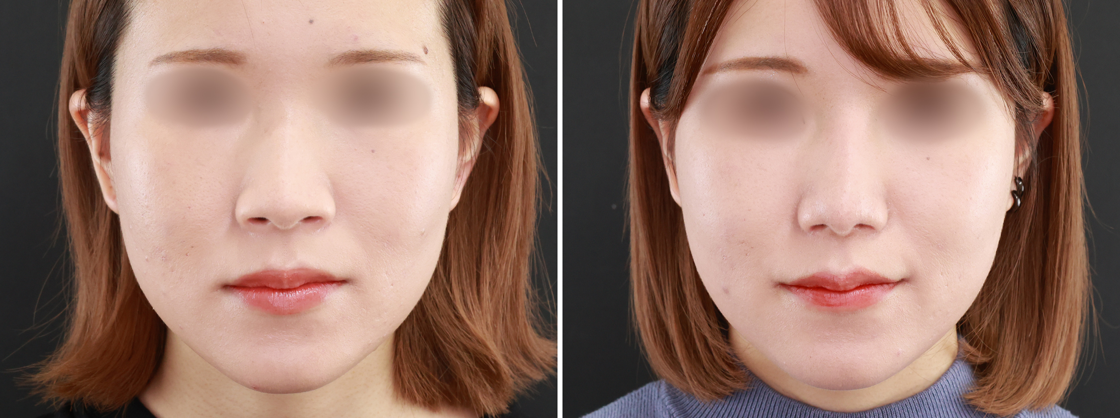 鼻尖形成・鼻尖縮小/鼻尖4Dノーズ/隆鼻術（プロテーゼ・自家組織）の症例写真 施術前後 ３ヵ月