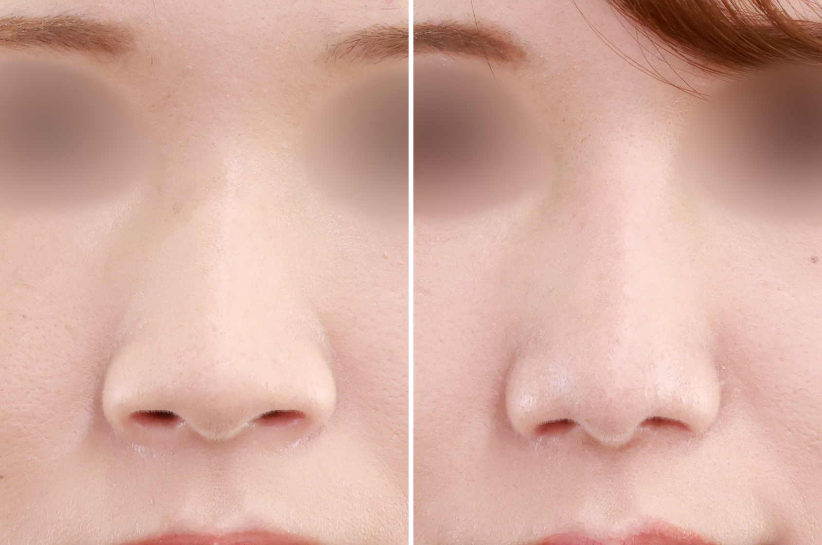 鼻尖形成・鼻尖縮小/鼻尖4Dノーズ/隆鼻術（プロテーゼ・自家組織）の症例写真 施術前後 ３ヵ月