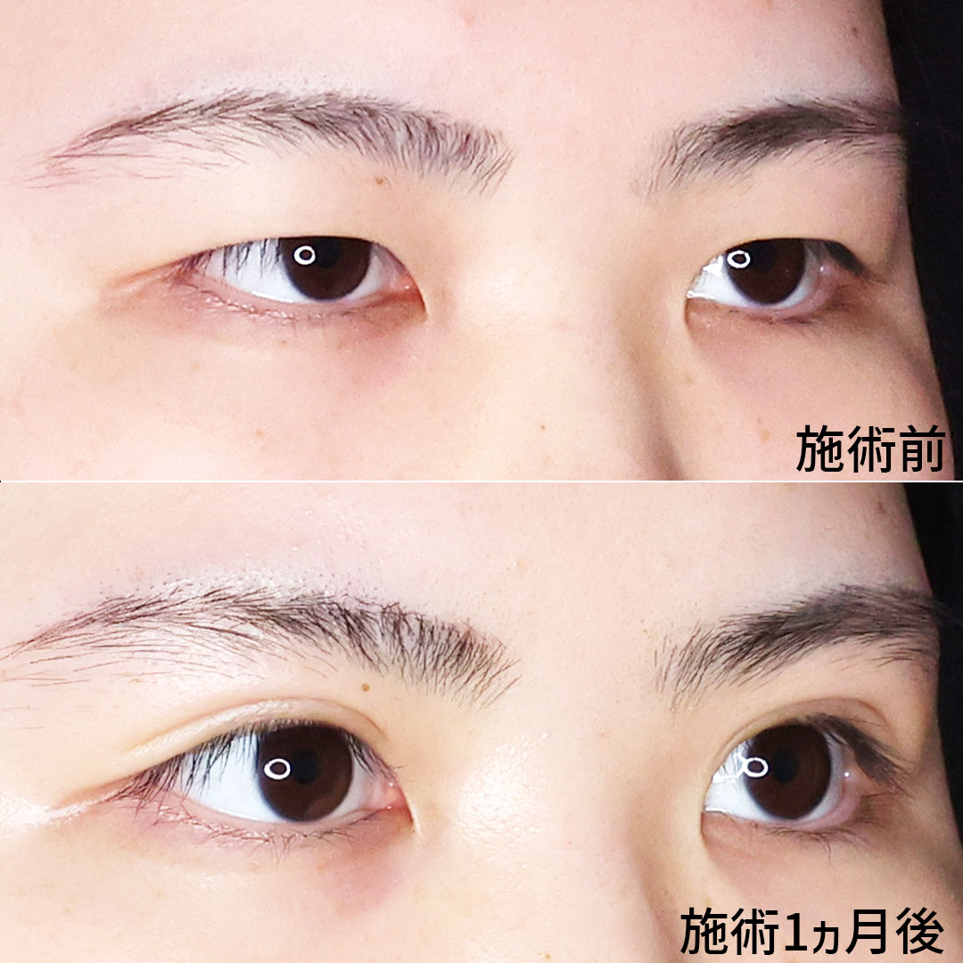 二重埋没法の症例写真 施術前後 