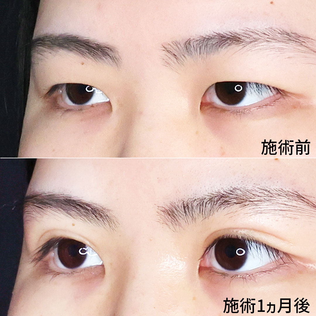 二重埋没法の症例写真 施術前後 