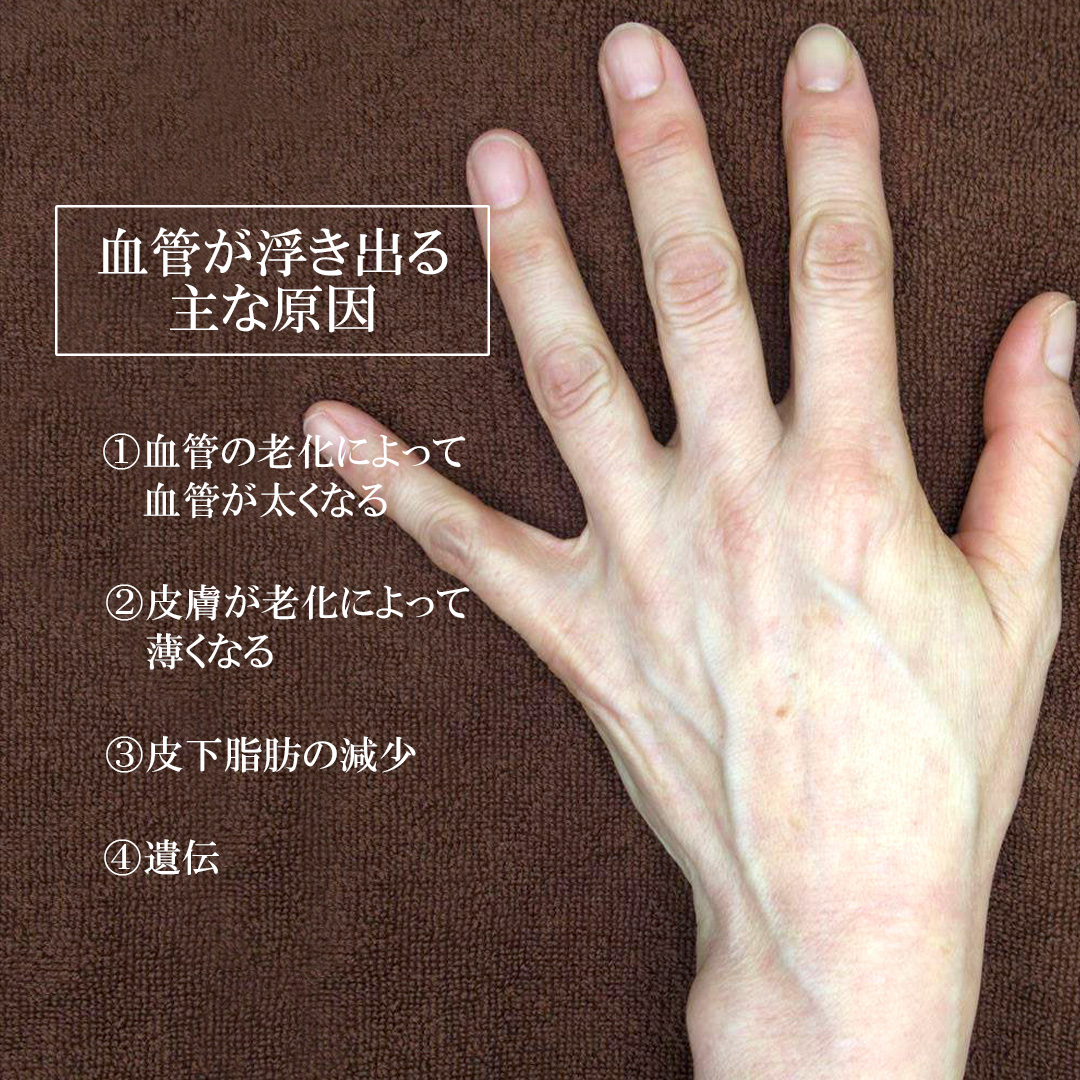 手の血管治療(ハンドベイン)の症例写真 施術前後