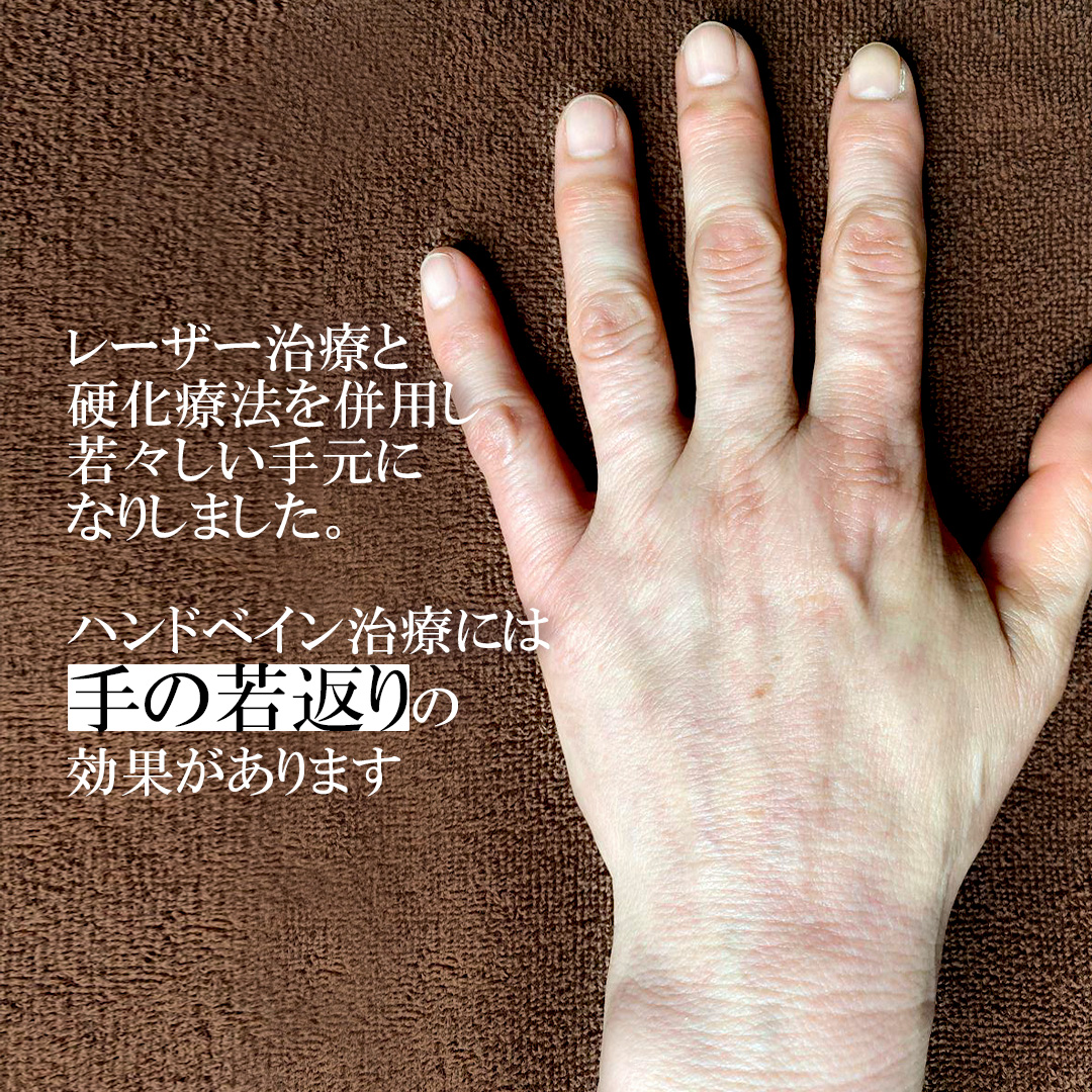 手の血管治療(ハンドベイン)の症例写真 施術前後