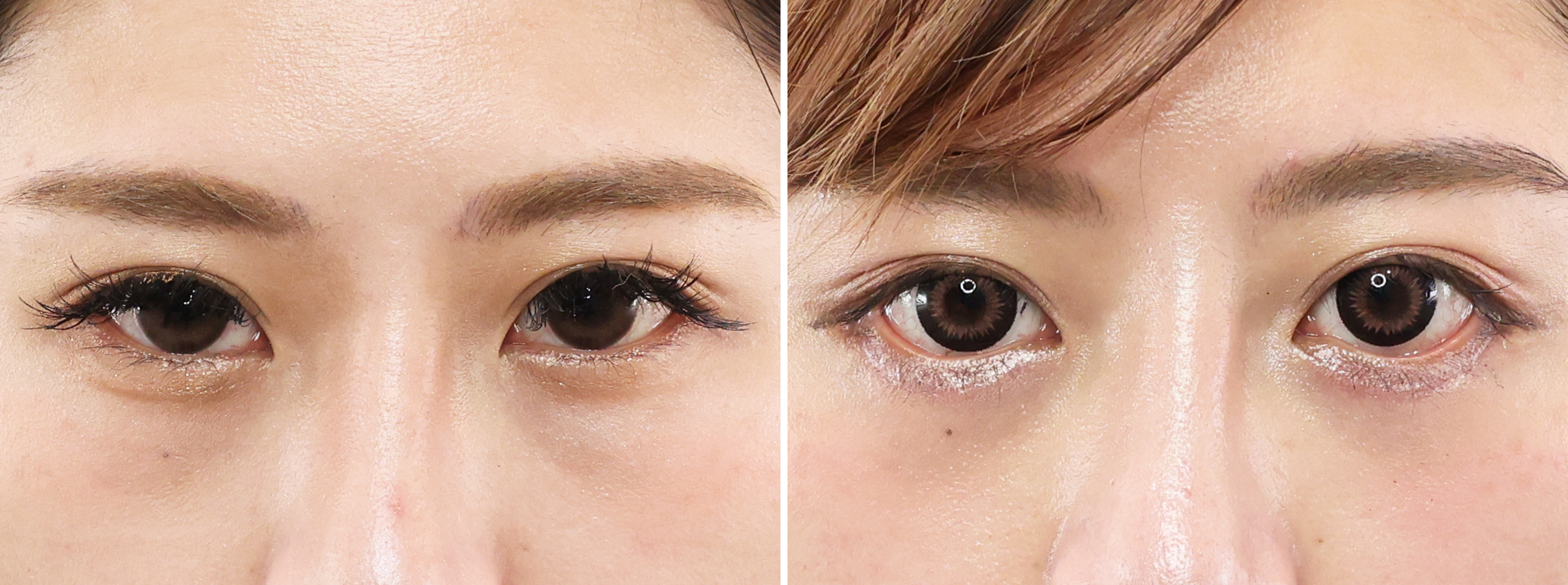 [たれ目形成+クマ取り]で愛され目元に