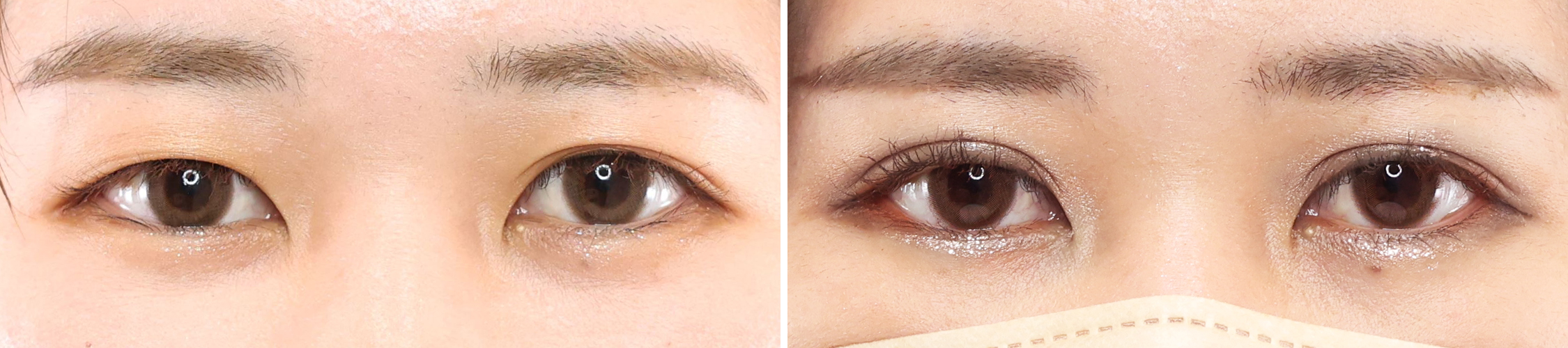 綺麗な平行二重でおしゃれを後押し