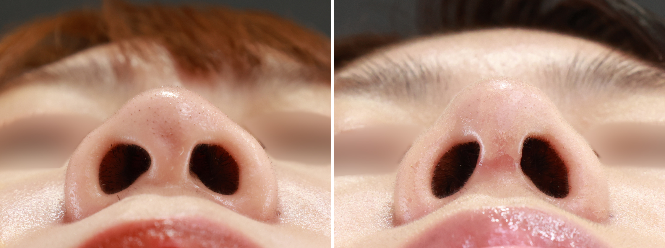 鼻尖形成・鼻尖縮小/鼻先軟骨移植の症例写真 施術前後 １ヵ月