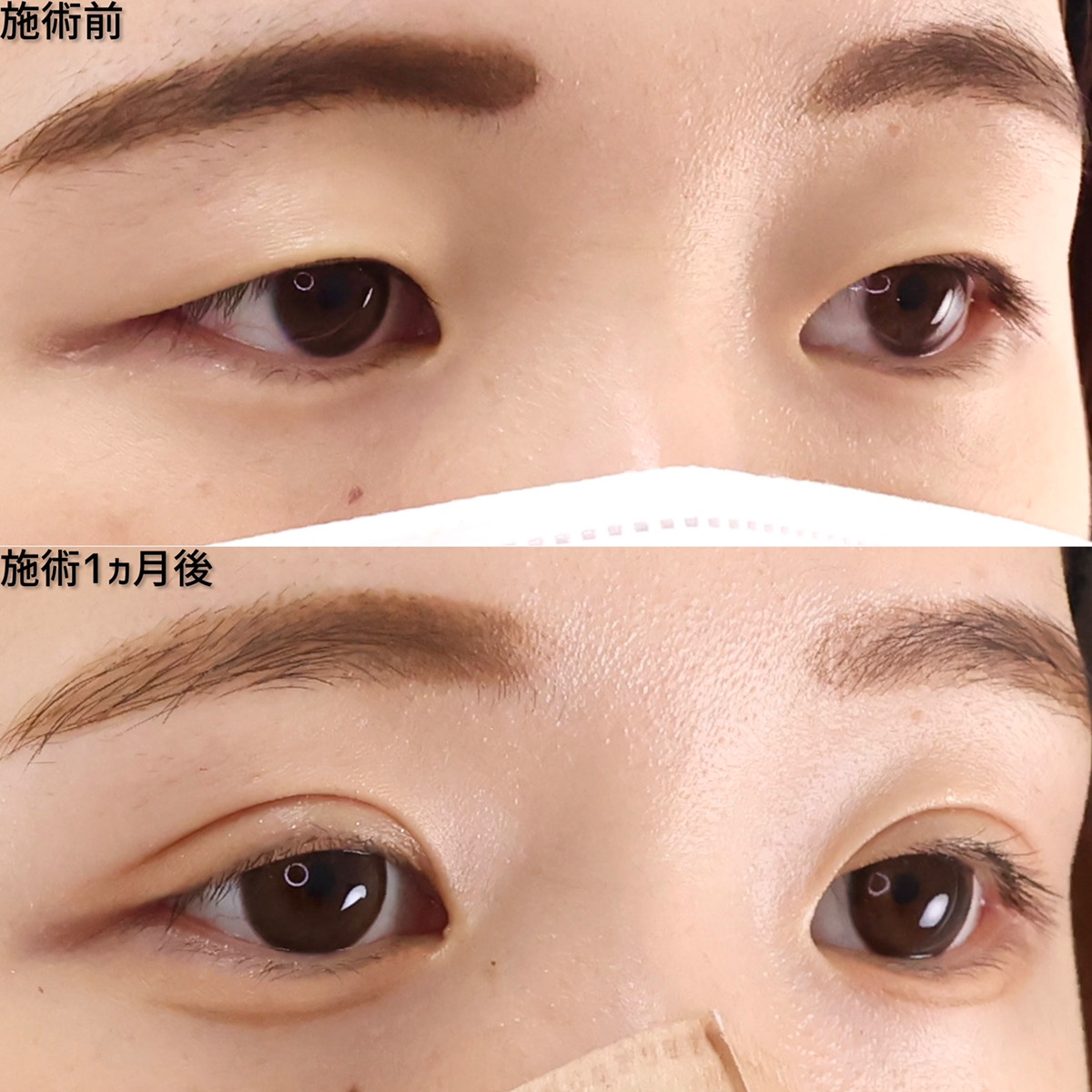 二重埋没法の症例写真 施術前後 １ヵ月