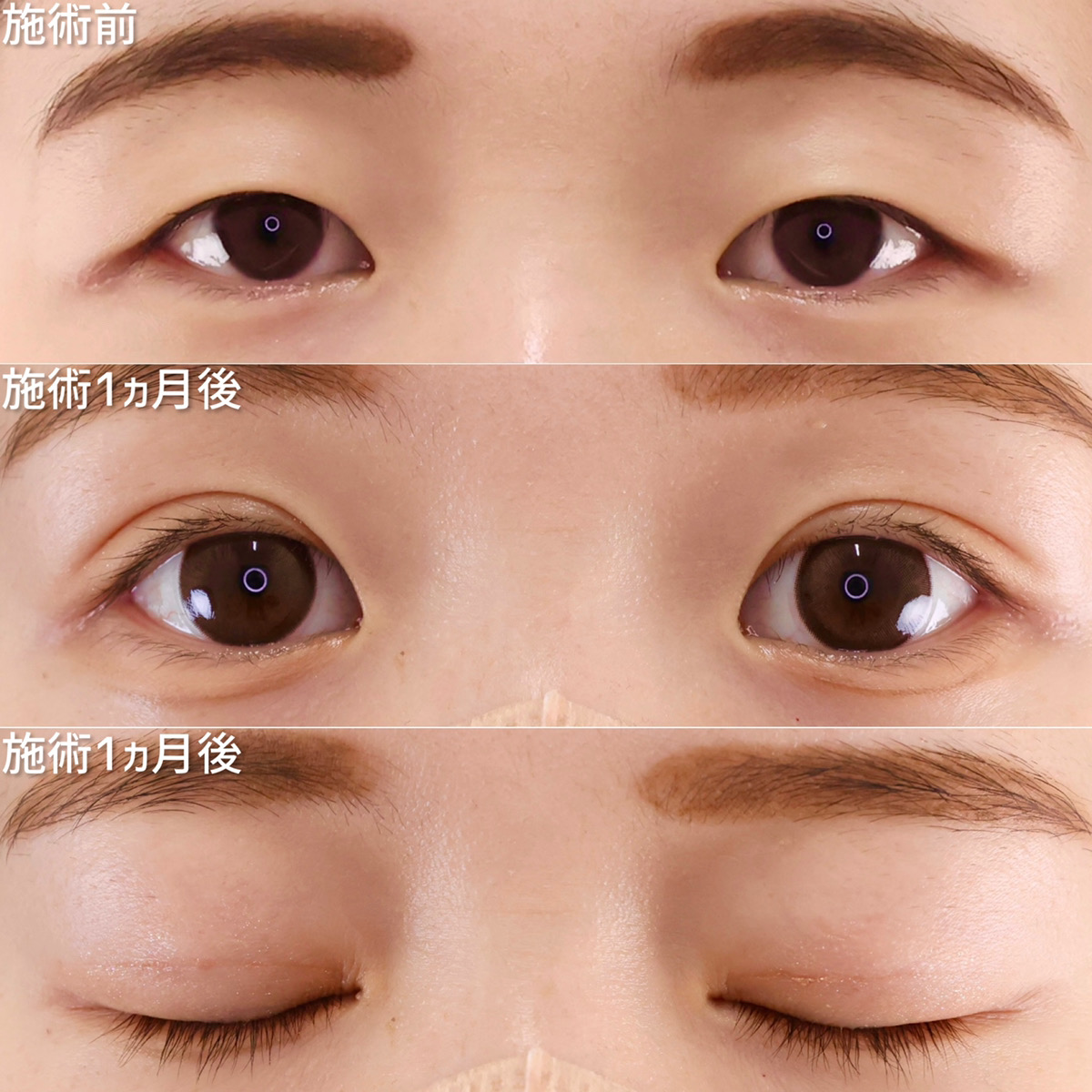 二重埋没法の症例写真 施術前後 １ヵ月