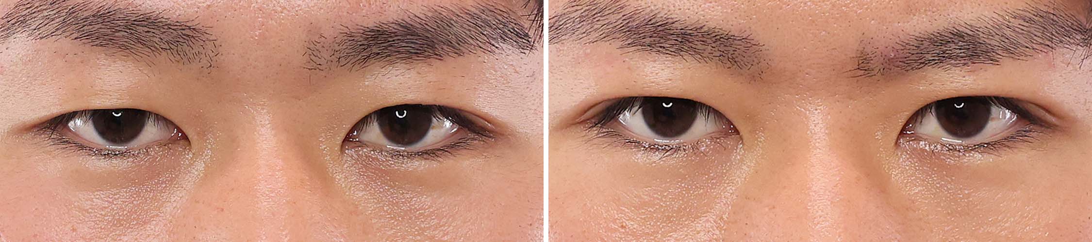 左右差のある目元をナチュラルに揃えて目力UP【二重埋没法】