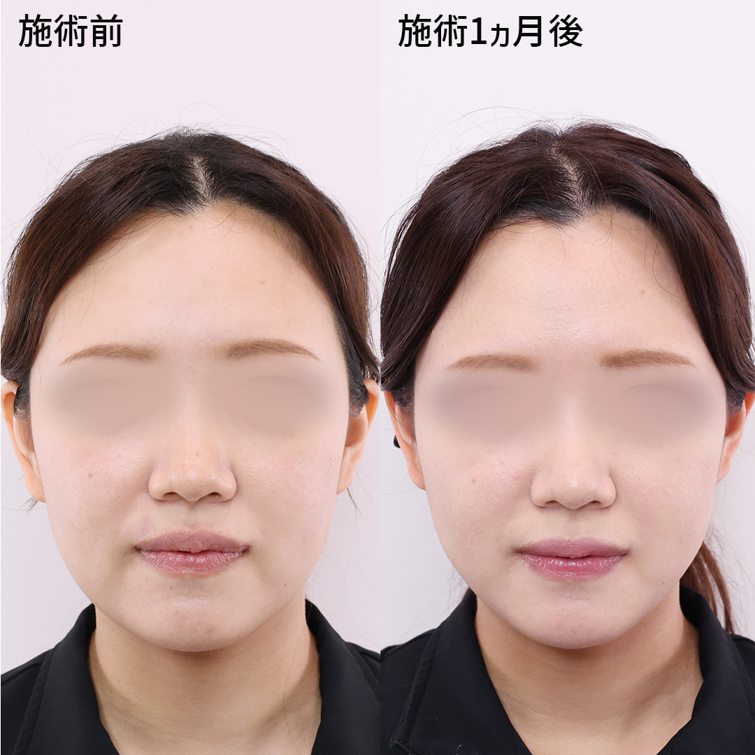 ダイエットでは叶わなかった…すっきりフェイスラインへ！