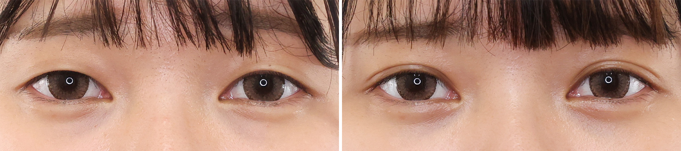 ノーメイクでもここまで変わる！二重整形で華やかな目元に