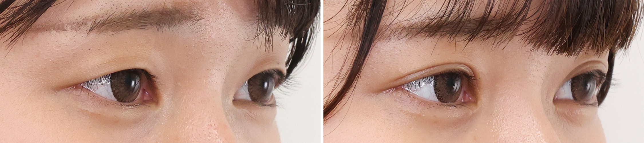 二重埋没法の症例写真 施術前後 １ヵ月