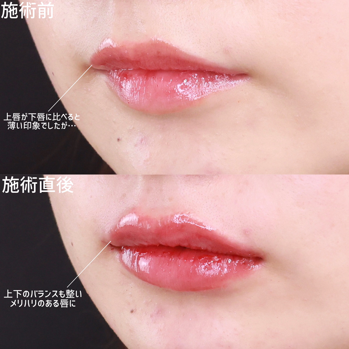 ヒアルロン酸注射：その他の症例写真 施術前後 