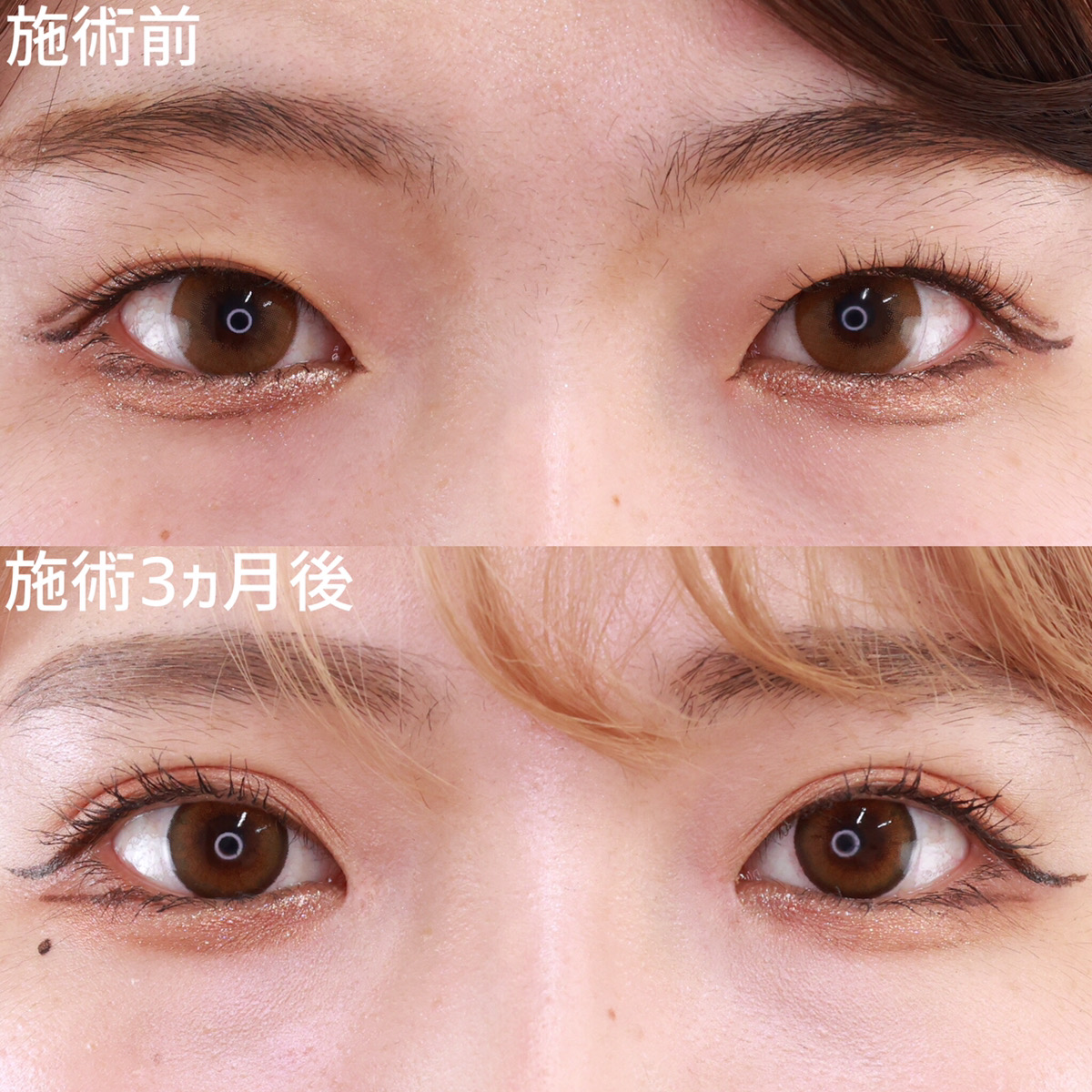 目頭メイクいらずの理想な目元|症例写真・ビフォーアフター|美容整形・美容外科のTAクリニックグループ 目頭メイクいらずの理想な目元|症例写真・ビフォーアフター|美容整形・美容外科のTAクリニックグループ