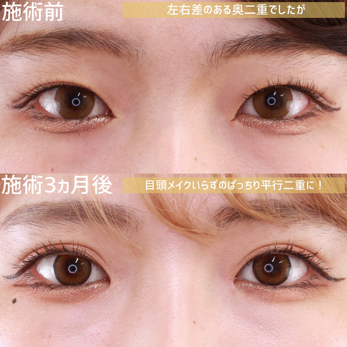 二重埋没法/目頭切開術の症例写真 施術前後 