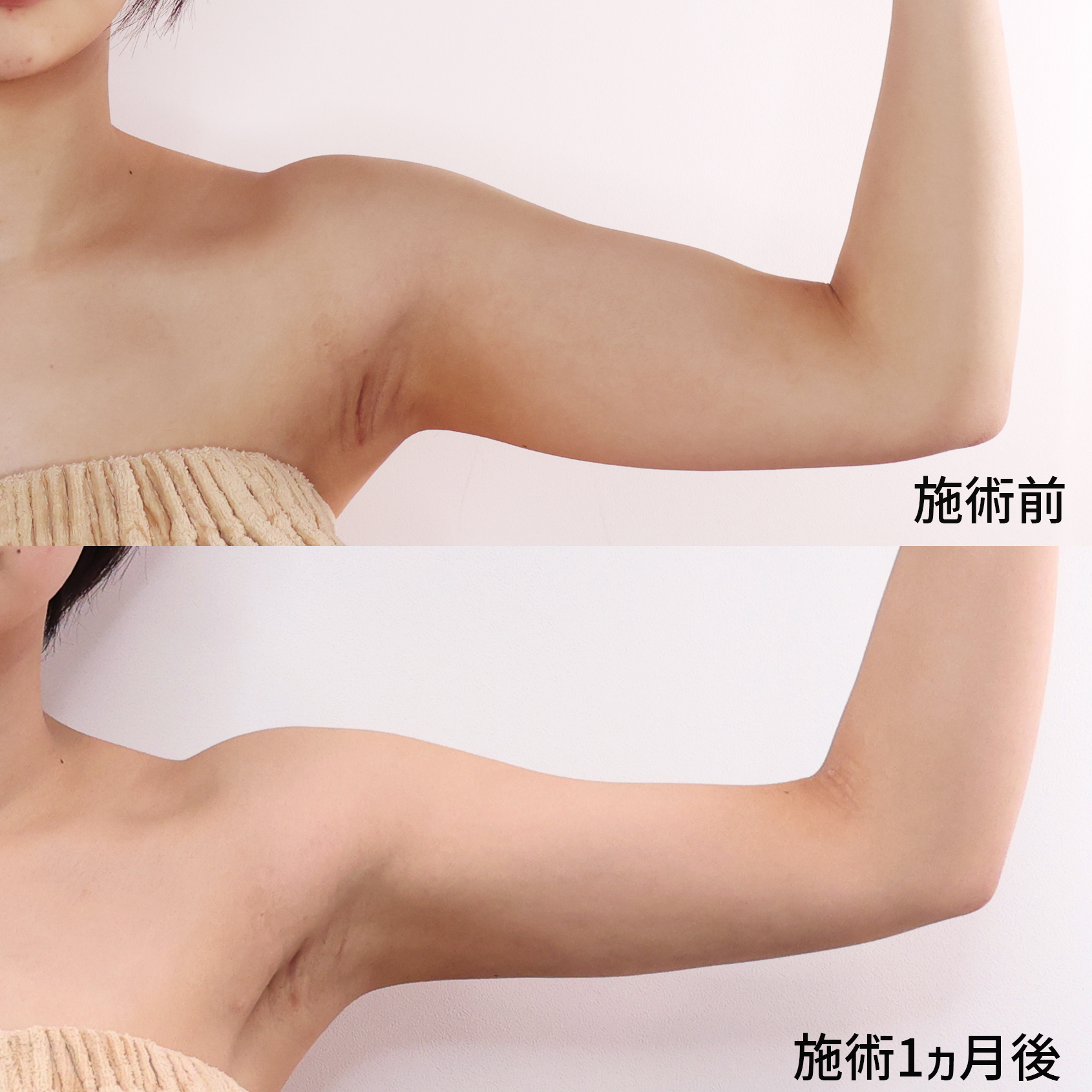 体の脂肪吸引の症例写真 施術前後 1ヵ月