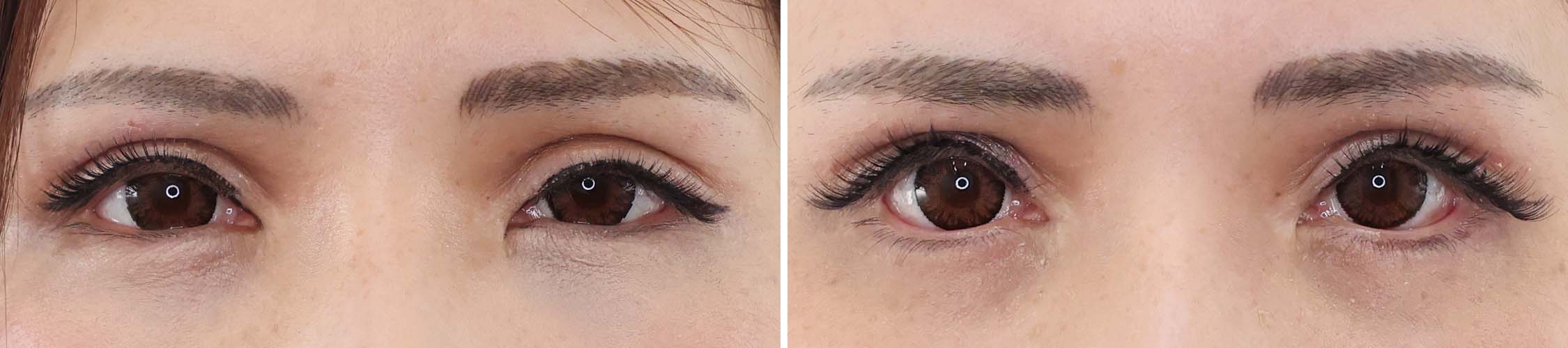 下垂ぎみだった目元の状態を【目つき矯正】と【タレ目形成】で愛らしく。