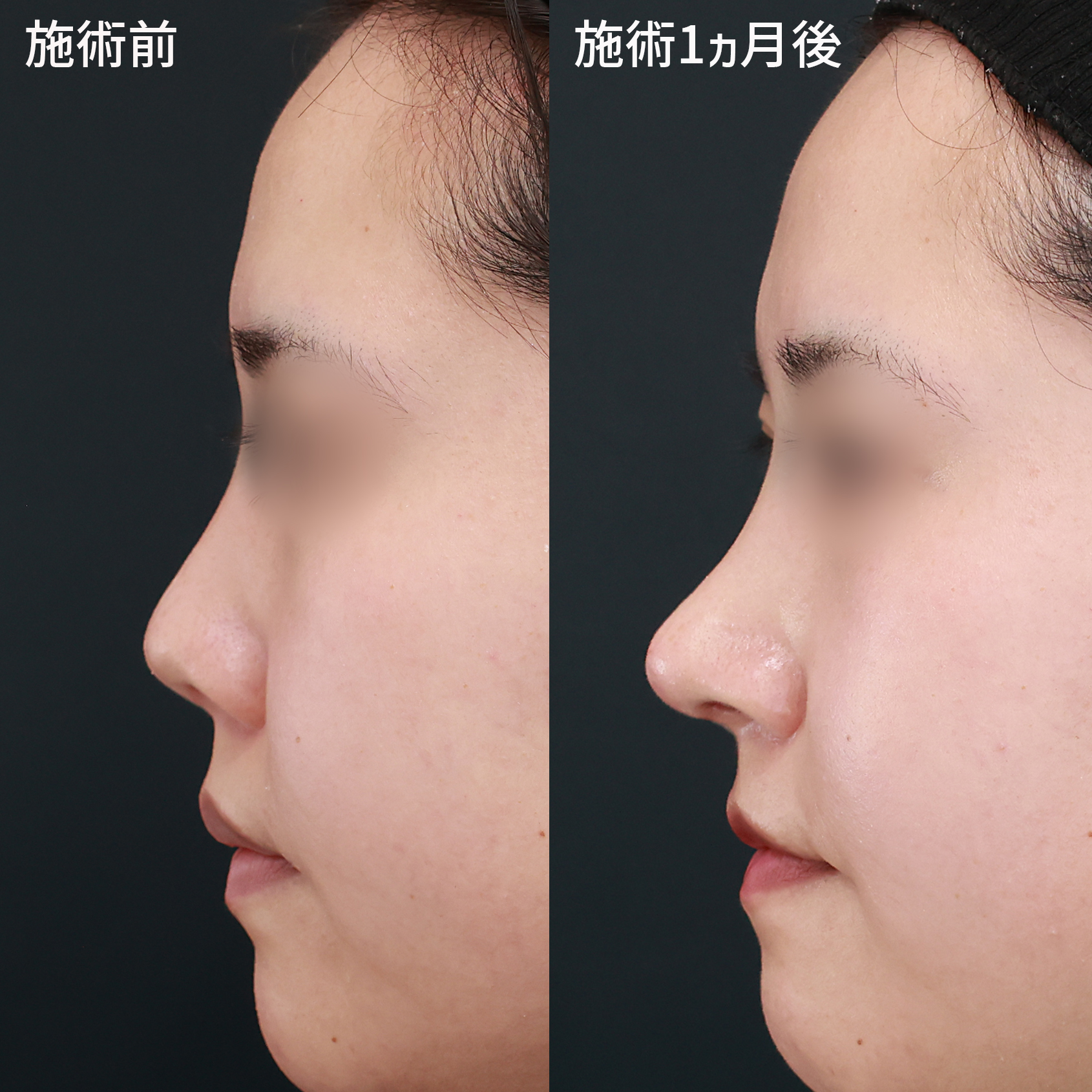 症例写真 ビフォーアフター ダウンタイム 副作用 鼻中隔延長で 今流行の韓国風アップノーズに Taクリニックグループ 美容整形 美容外科 全国展開中