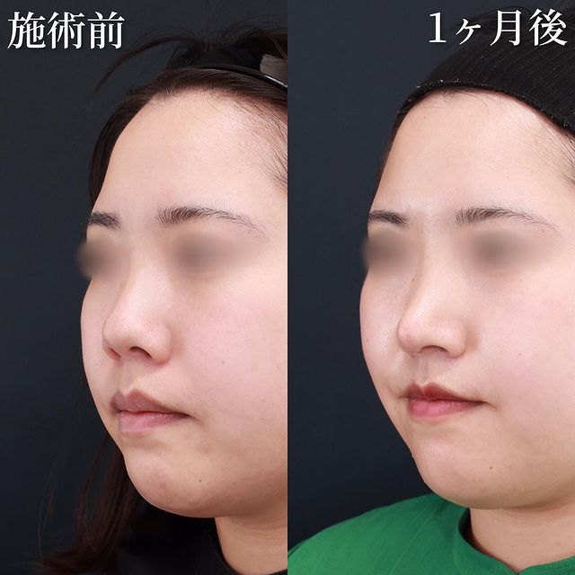 鼻中隔延長術/鼻尖形成・鼻尖縮小/鼻先軟骨移植の症例写真 施術前後 