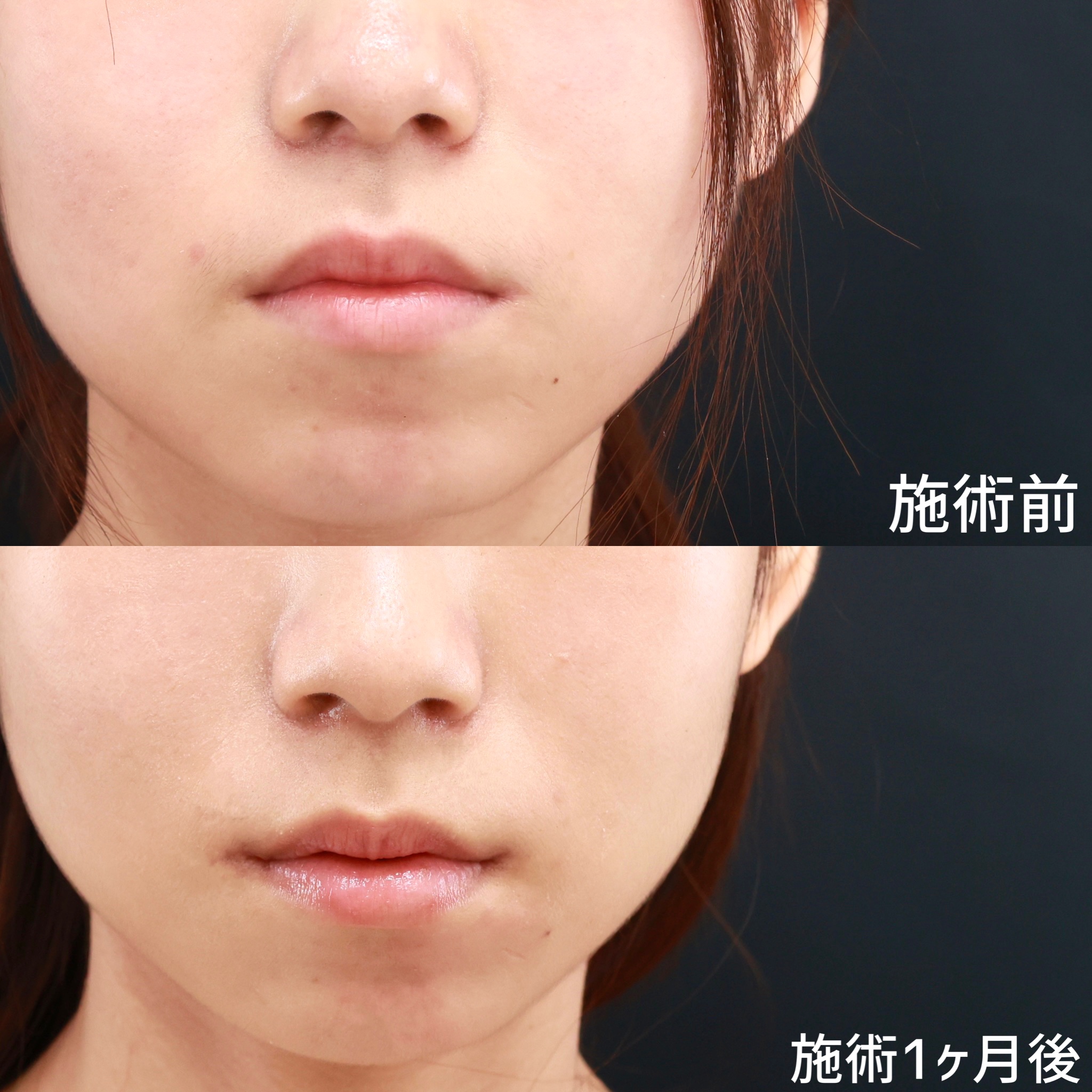 新施術!!『傷跡が外から見えない』口角挙上(口内法/内側法)