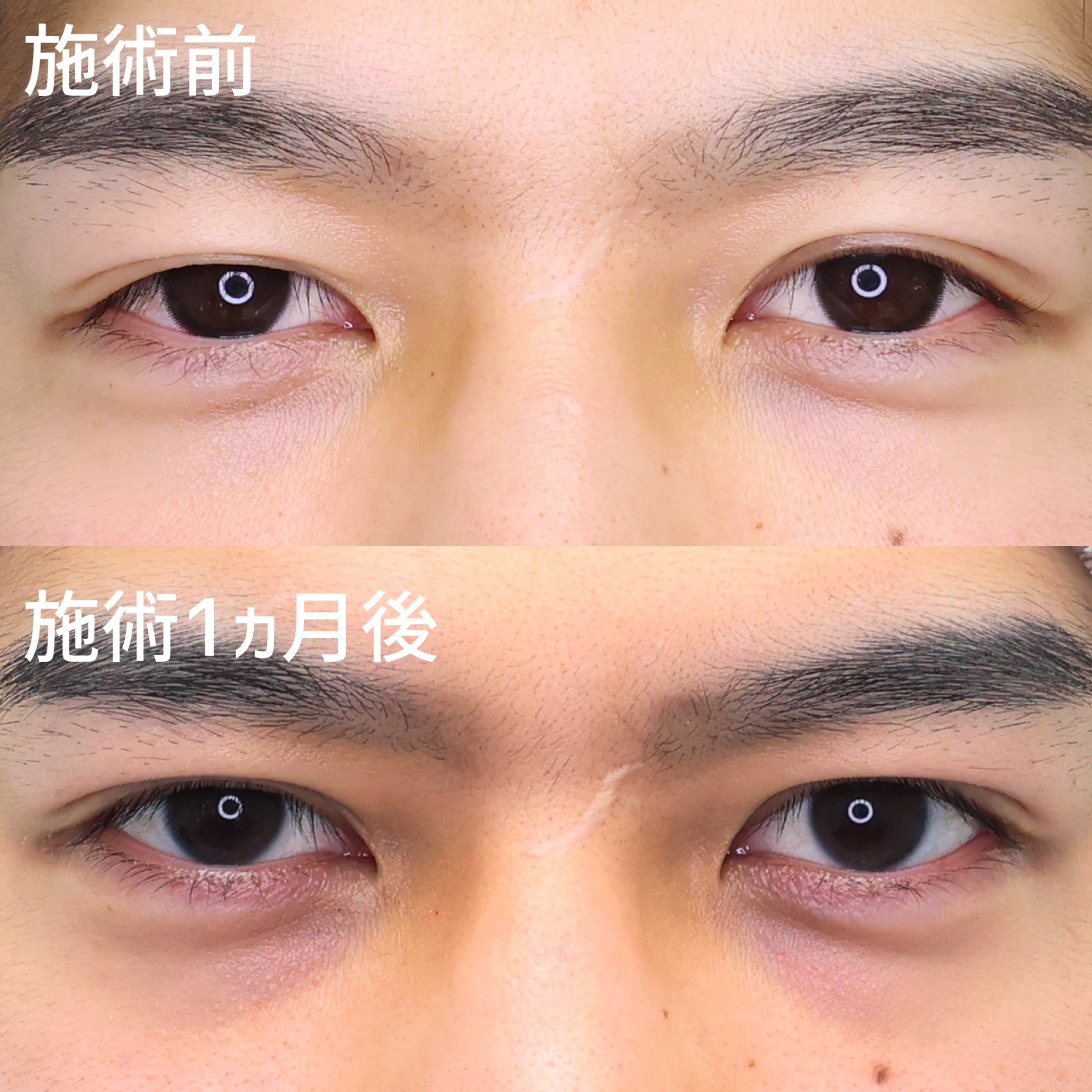 気になる目元の左右差を改善！まばたきしてもバレづらい【二重埋没法】！！