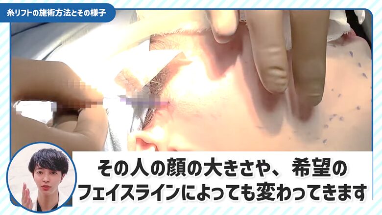 糸リフトの本数