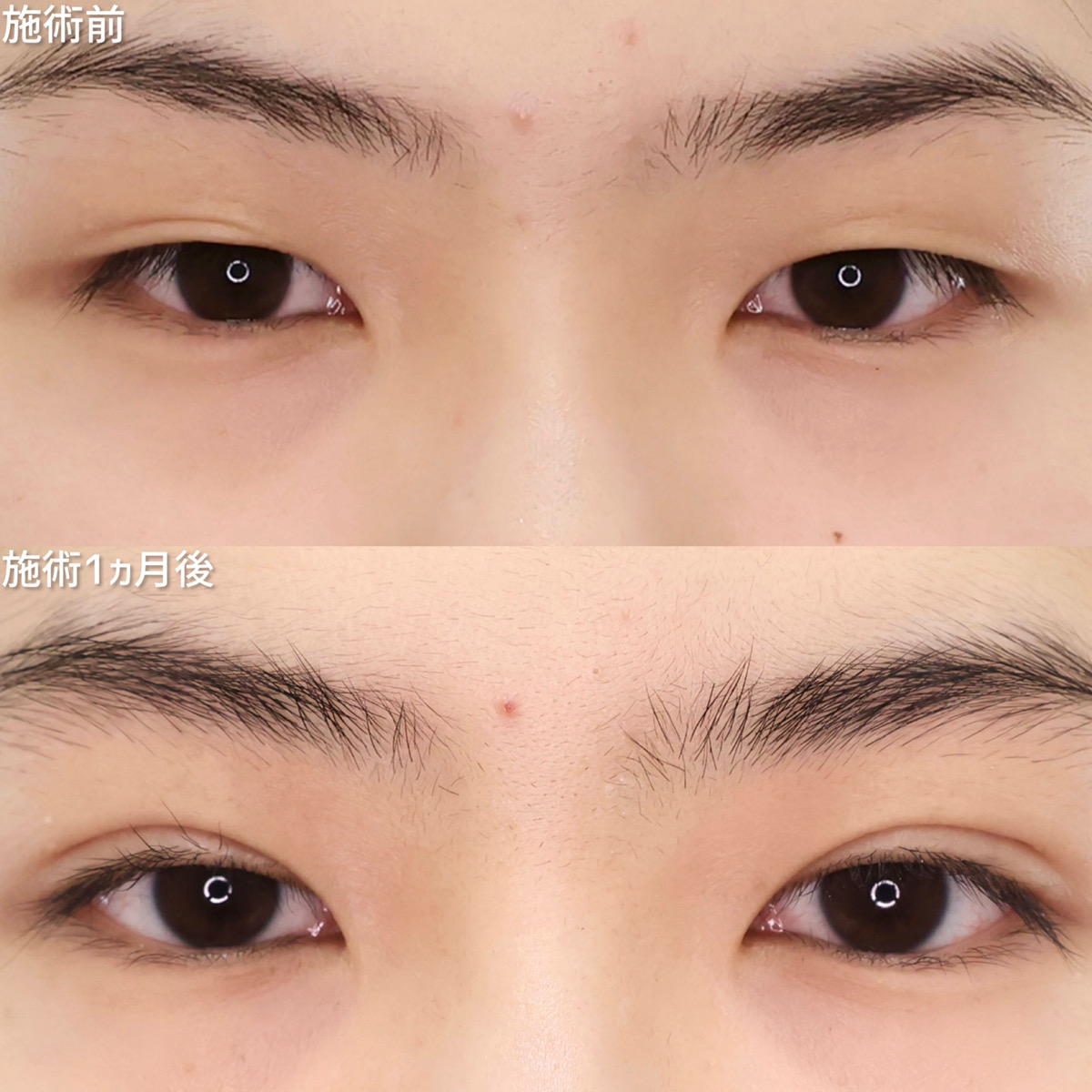 女医ならではのデザイン力でつくる凛とした女優eye【二重埋没法】