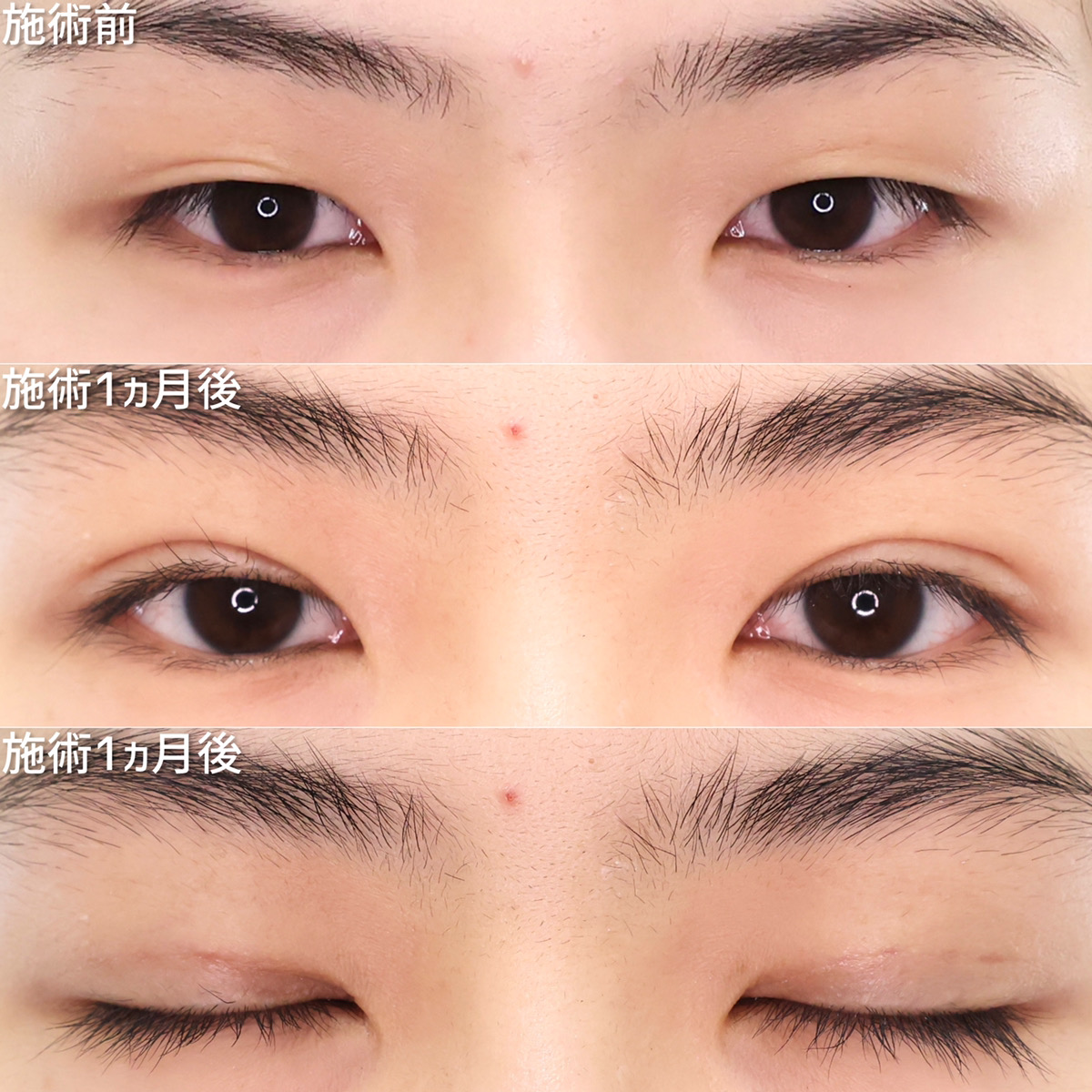 二重埋没法の症例写真 施術前後 1ヵ月