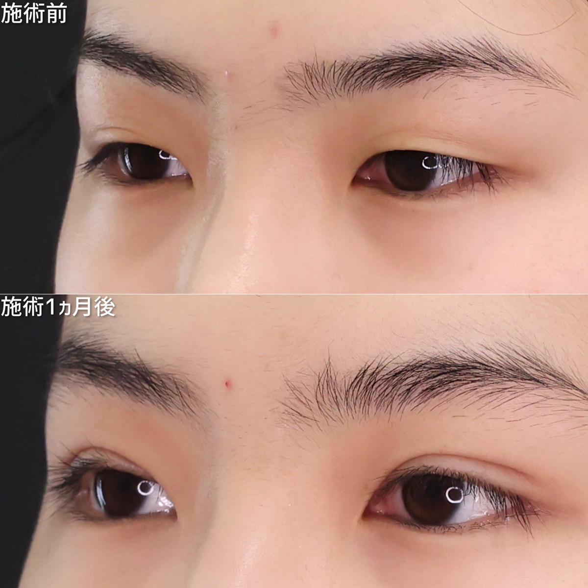 二重埋没法の症例写真 施術前後 1ヵ月