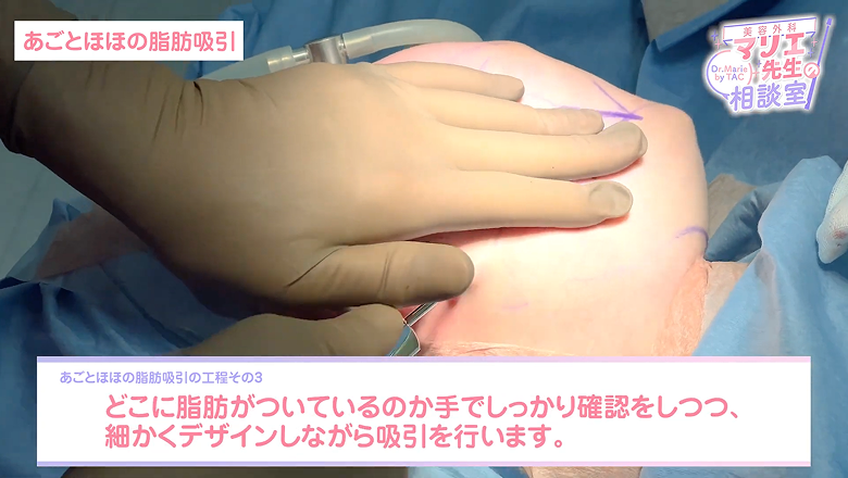 脂肪のつき方を手で確かめながら吸引していく場面