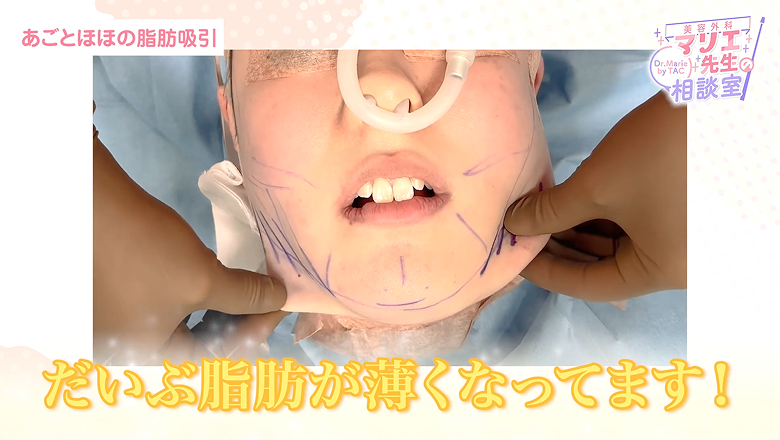 片側の脂肪吸引を終えて薄くなった顎下と頬を確かめる場面