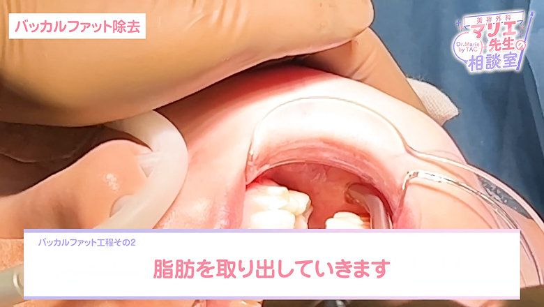 口の中から頬の奥にある脂肪を取り出していく様子