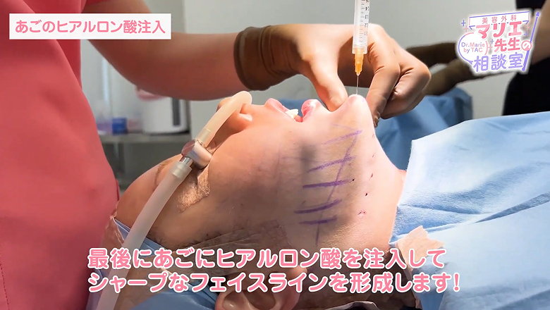 仕上げに顎へヒアルロン酸を注入している様子