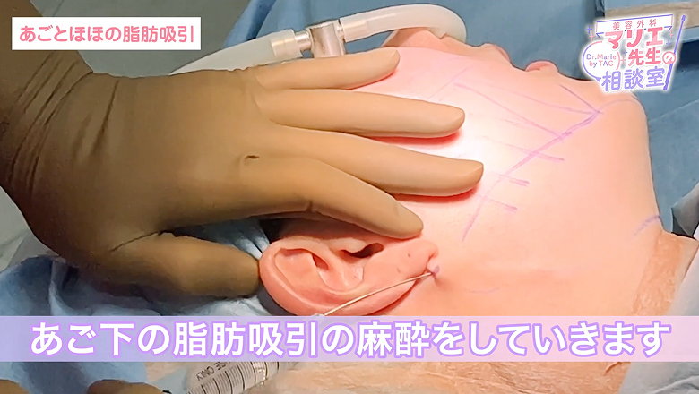 デザイン線を引いた顎下に麻酔を行っている様子