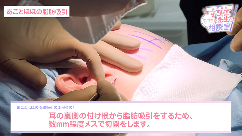 耳の裏の付け根を数mm切開して吸引口をつくる様子