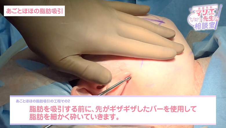 先がギザギザしたバーで脂肪を細かく砕いていく場面