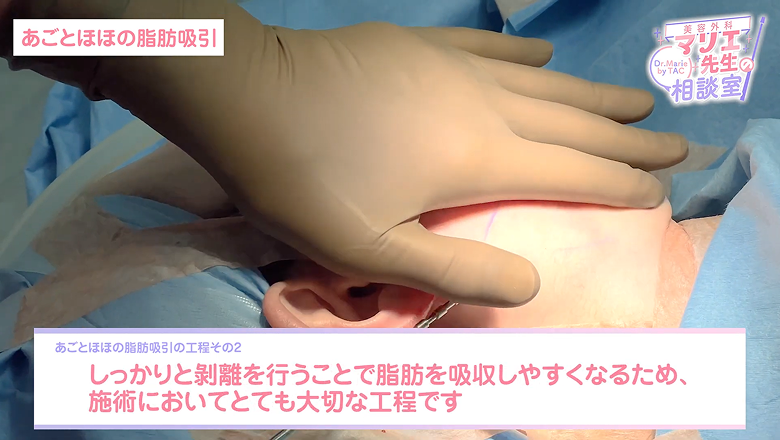 脂肪を吸引しやすくするため剥離を進めている場面